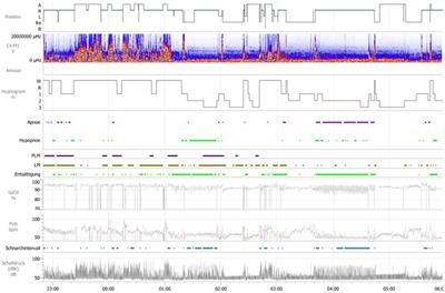 Case report: An OSAS patient with comorbid RLS/PLMS – a closer look at the causes of PAP intolerance